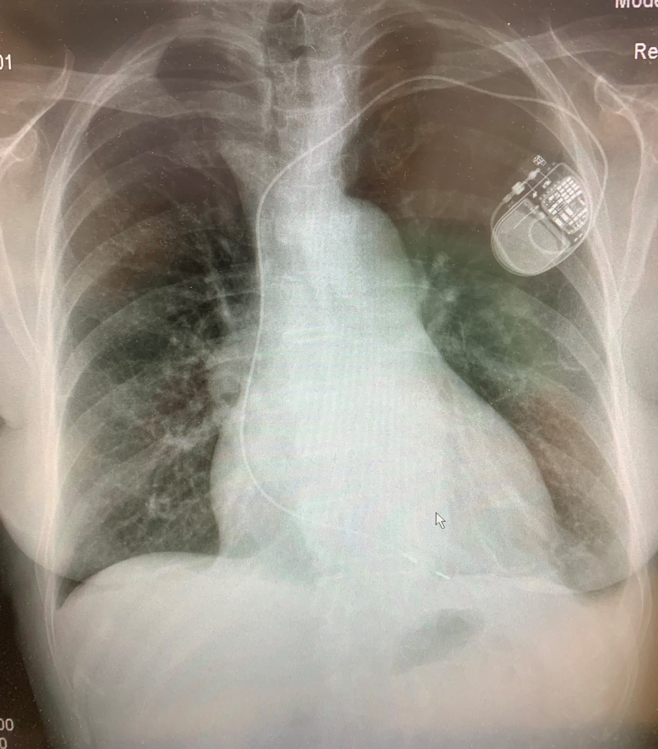 Viver com um pacemaker - ICV
